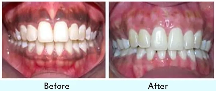 Gum depigmentation Bangalore