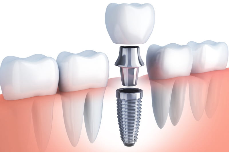Dental implants Bengaluru overview