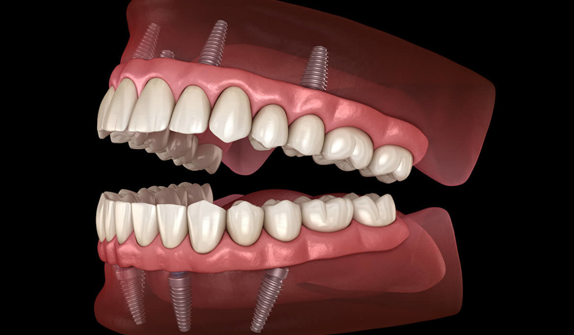 Full mouth rehabilitation basal implants Bengaluru