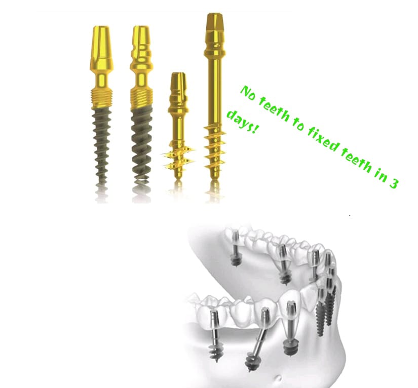 Basal implants cortical bone same day teeth Bengaluru