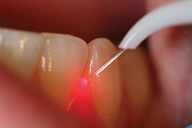 LASER dental treatment Bangalore