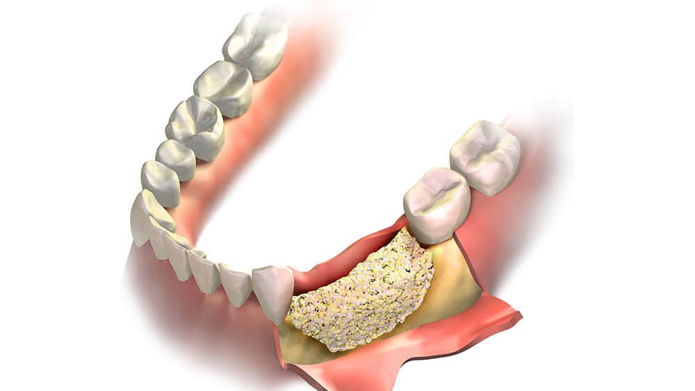 Bone graft dental Bangalore
