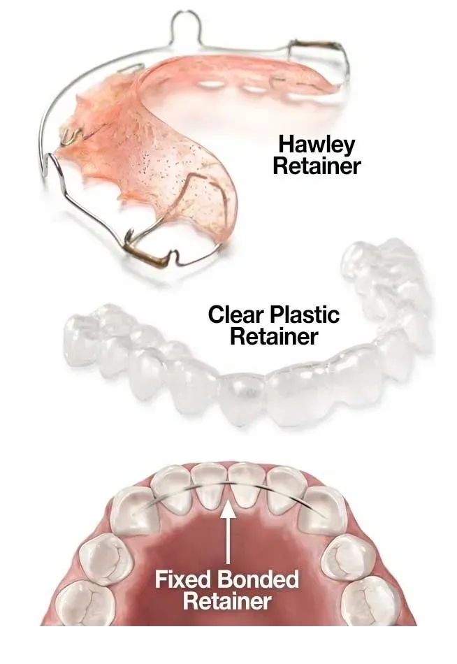 Dental retainers after braces
