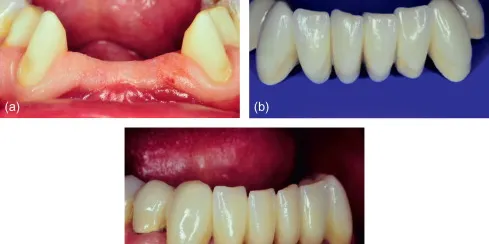 Fixed partial dentures bridge