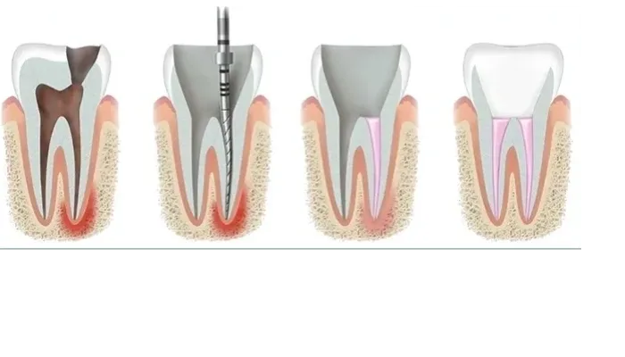 Root canal treatment RCT procedure